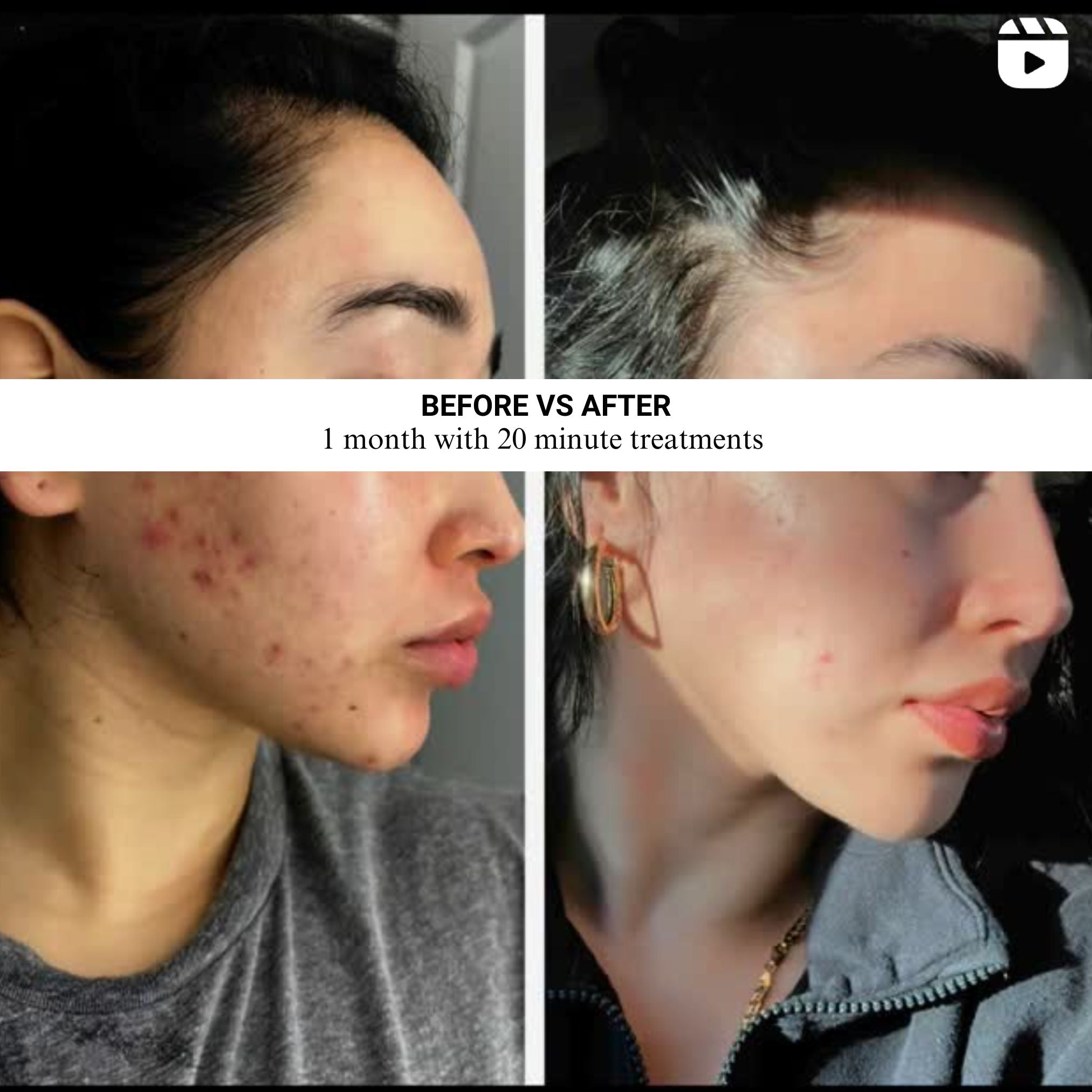 Side-by-side before-and-after image showing skin improvement over one month with 20-minute treatments, reducing acne and redness.