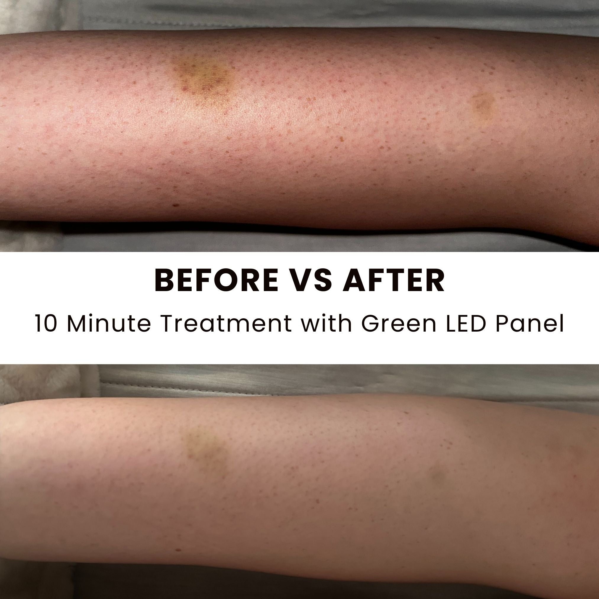 Before-and-after image showing reduced discoloration on the skin after a 10-minute treatment with a green LED panel.