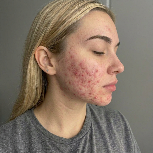 Breakouts & Scaring — before