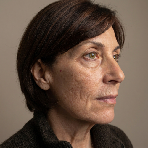 Softened fine lines & wrinkles — before